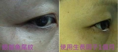 針對眼部魚尾紋 使用生長因子1個月 使用前後