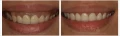 水雷射牙齦整形 牙冠增長術+牙齦淨白術+頂級全瓷冠