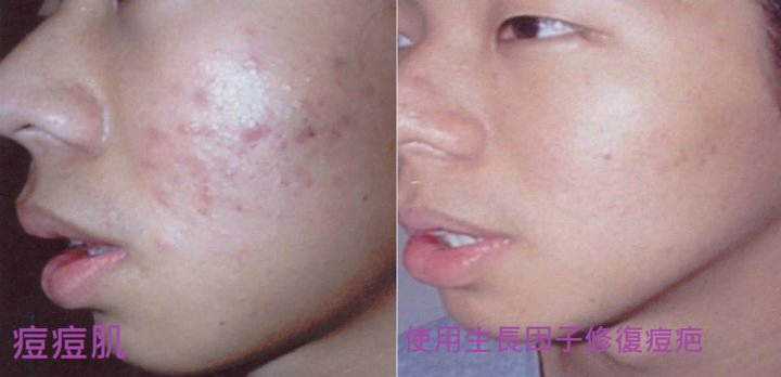 針對痘痘肌 使用生長因子修復痘疤