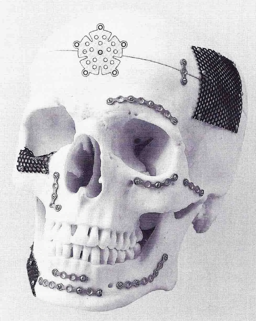 鈦金屬顱顏重建骨釘骨板系統