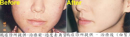 治療前治療後，點看放大圖