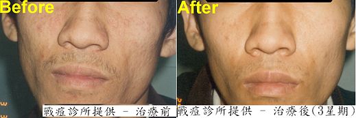 治療前治療後，點看放大圖